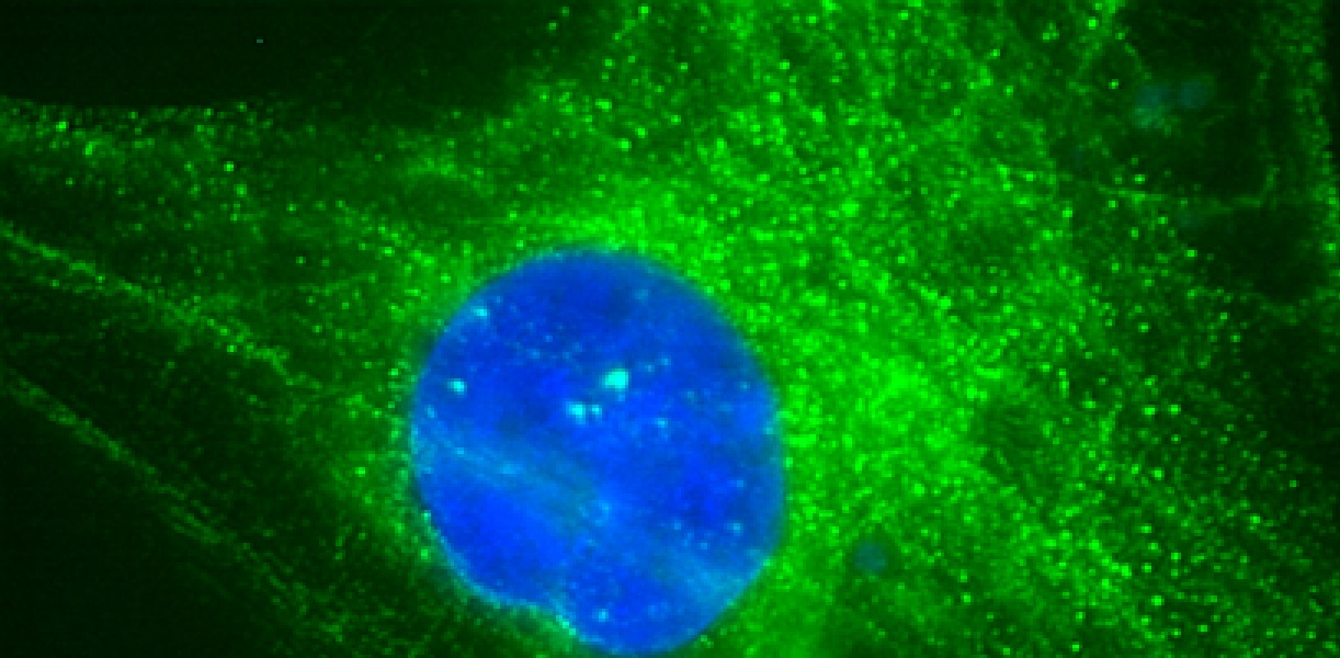 La Fibromatori Desmoide al microscopio