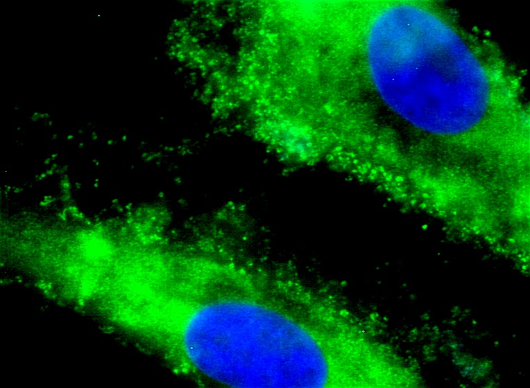 Cellule al microscopio fibromatosi desmoide